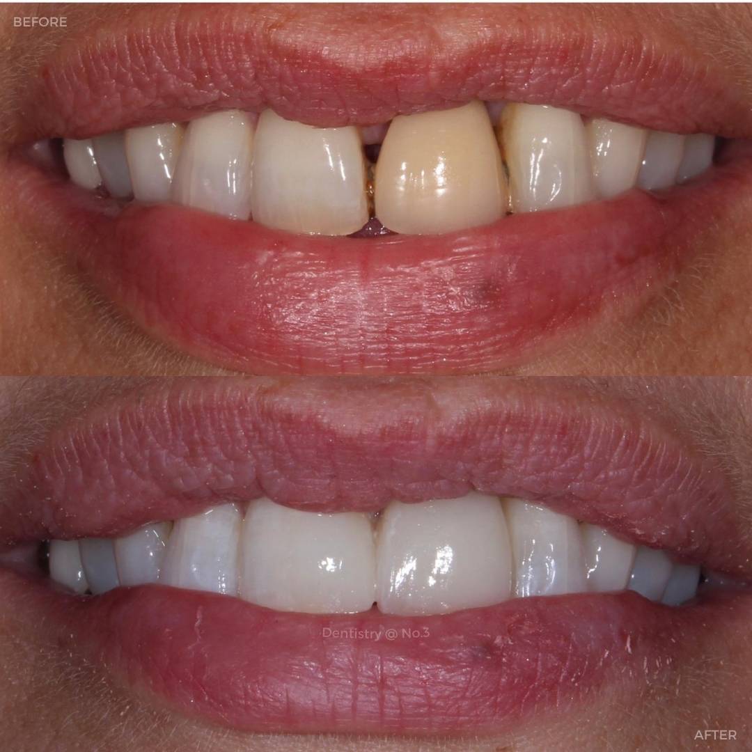 Before and after treatment at Dentistry @ No.3 in Dunfermline