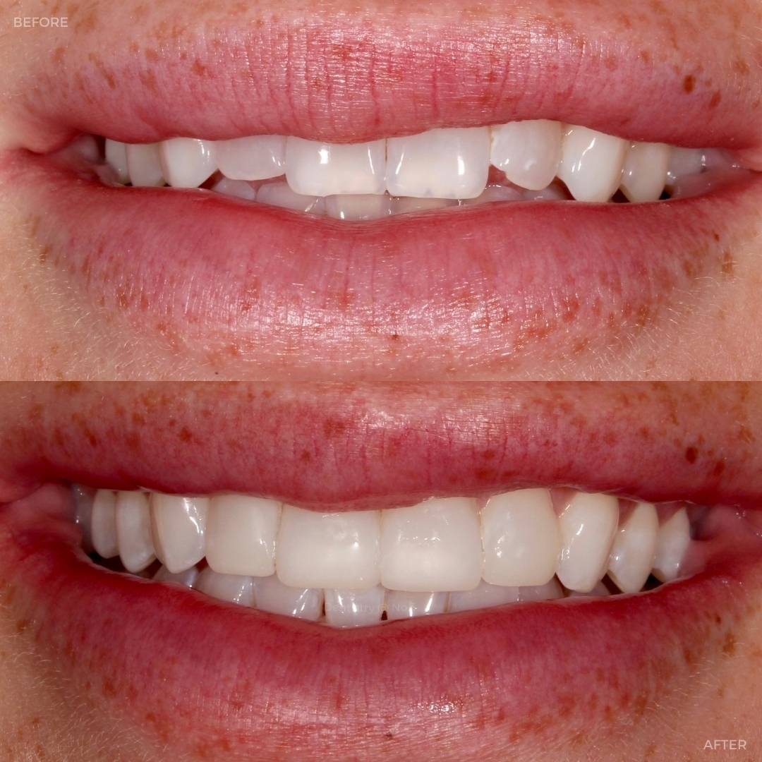 Before and after treatment at Dentistry @ No.3 in Dunfermline