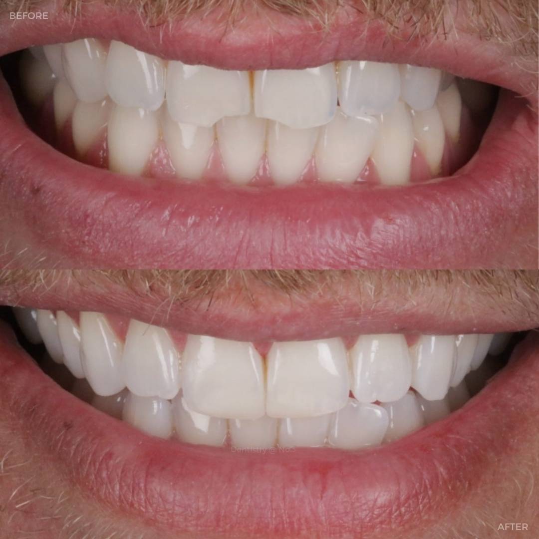 Request A Complimentary Consultation | Dentistry @ No.3 & Century House Before and after treatment at Dentistry @ No.3 in Dunfermline