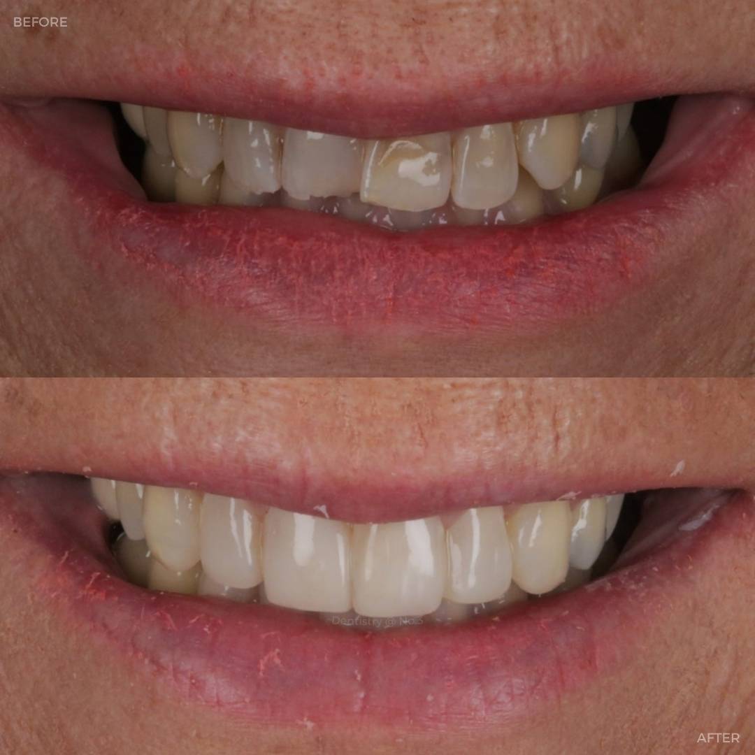 Request A Complimentary Consultation | Dentistry @ No.3 & Century House Before and after treatment at Dentistry @ No.3 in Dunfermline