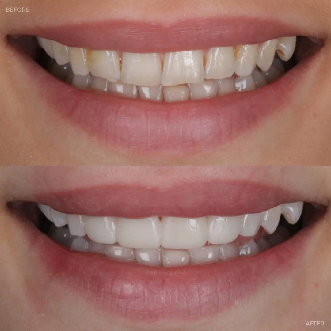 Before and after treatment at Dentistry @ No.3 in Dunfermline