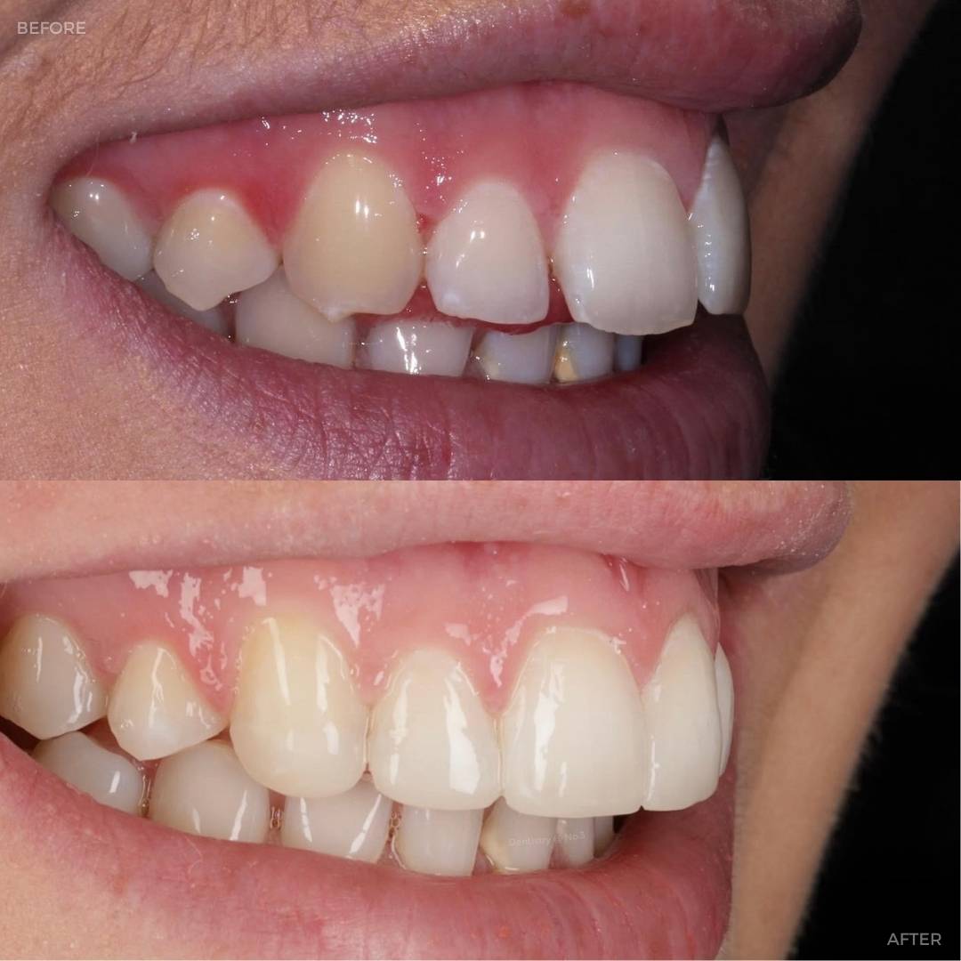Request A Complimentary Consultation | Dentistry @ No.3 & Century House Before and after treatment at Dentistry @ No.3 in Dunfermline