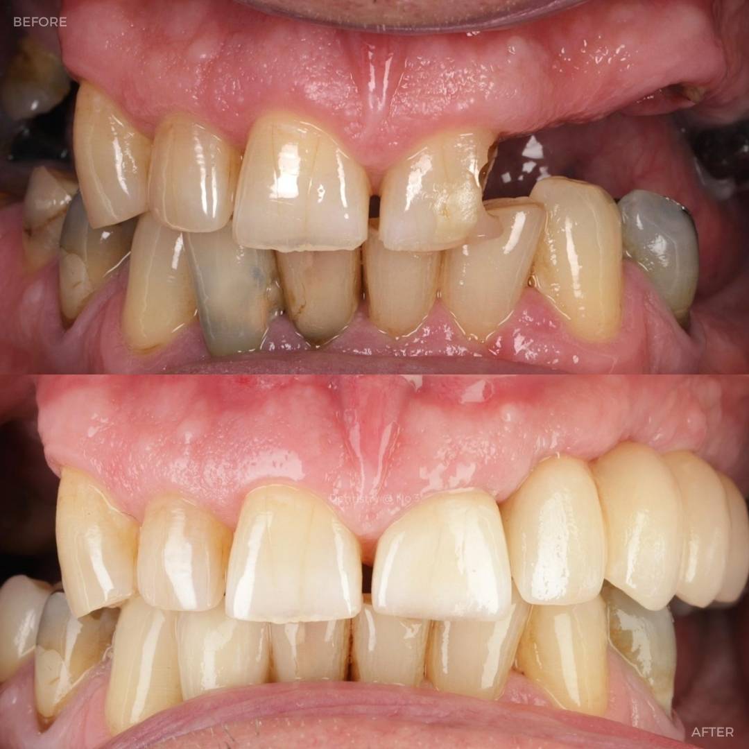 Request A Complimentary Consultation | Dentistry @ No.3 & Century House Before and after treatment at Dentistry @ No.3 in Dunfermline