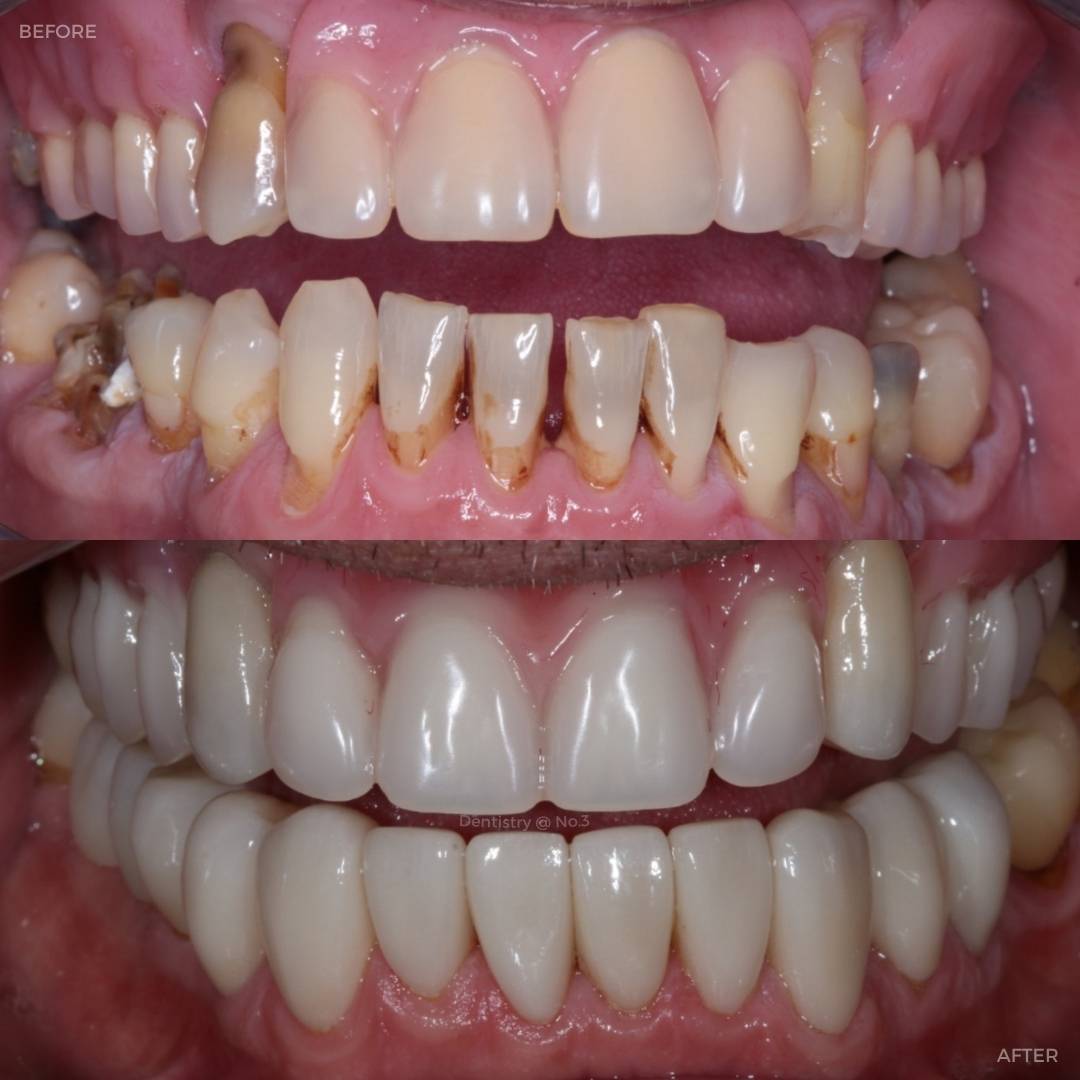 Request A Complimentary Consultation | Dentistry @ No.3 & Century House Before and after treatment at Dentistry @ No.3 in Dunfermline