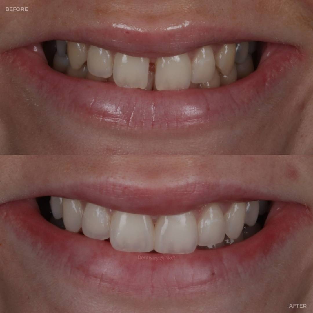 Before and after treatment at Dentistry @ No.3 in Dunfermline