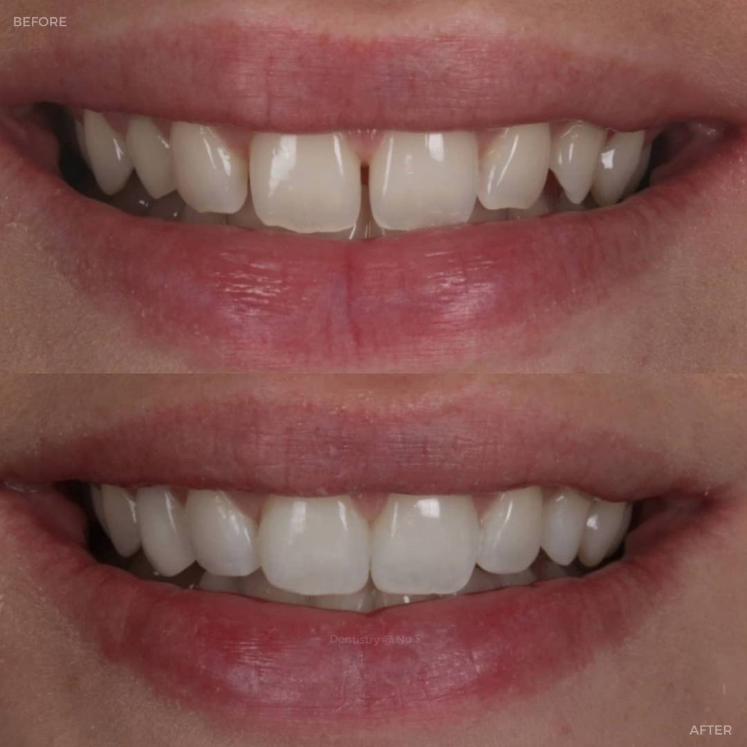 Before and after treatment at Dentistry @ No.3 in Dunfermline