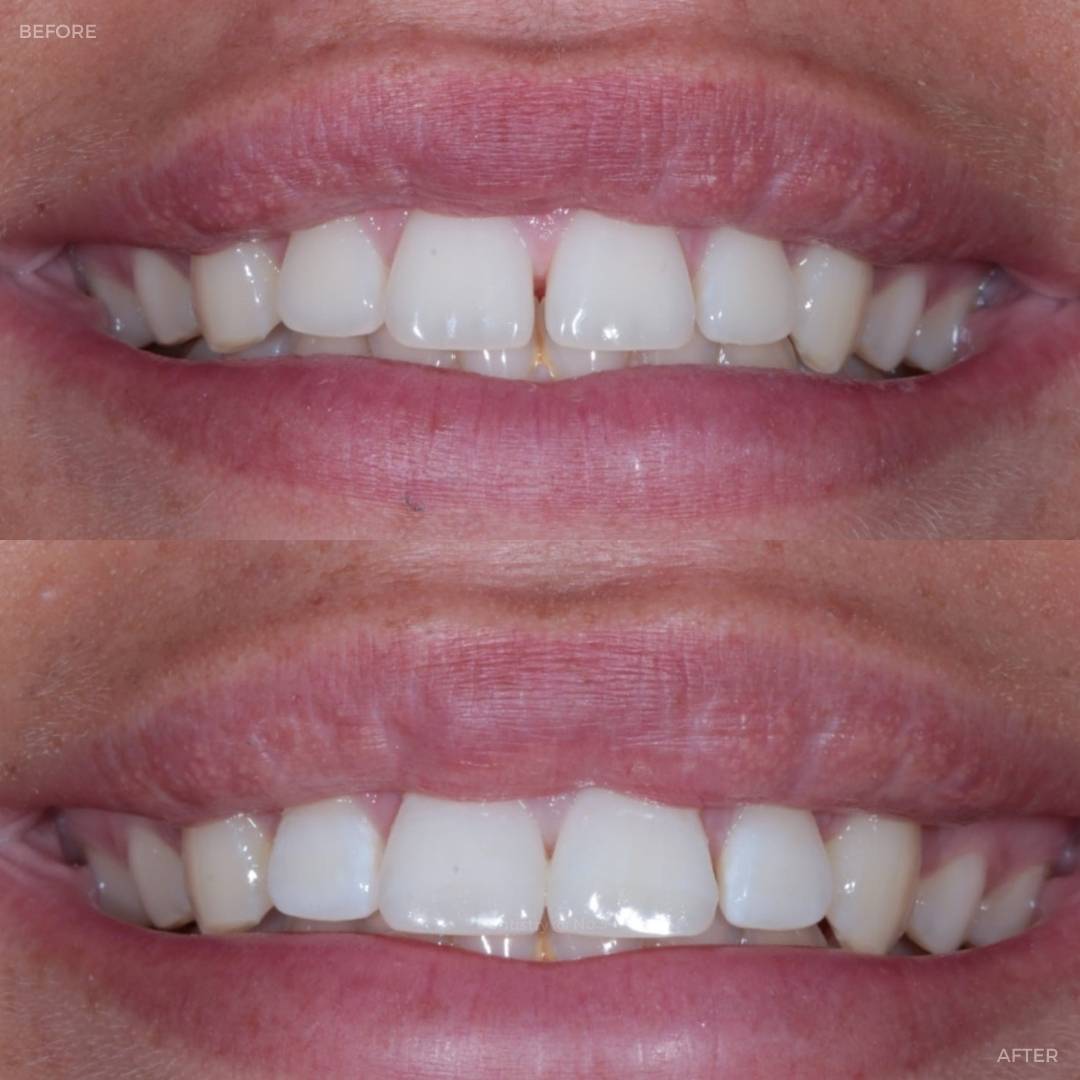Before and after treatment at Dentistry @ No.3 in Dunfermline