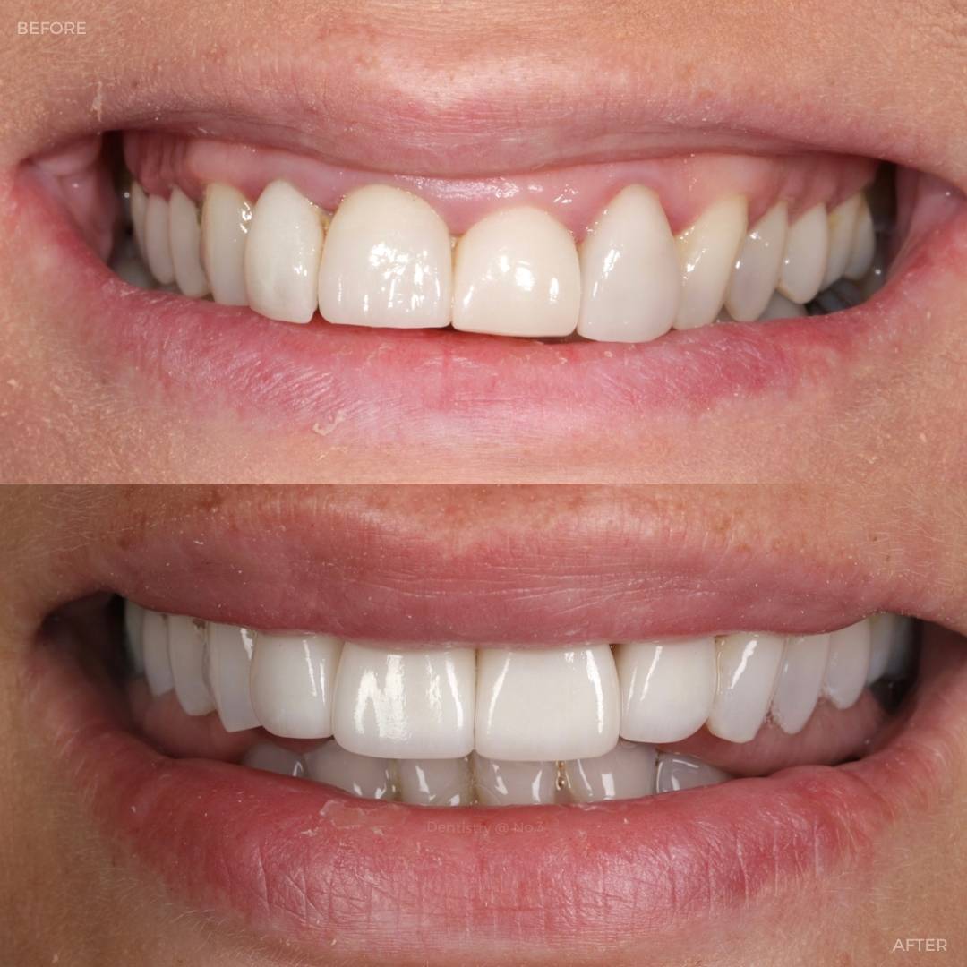 Request A Complimentary Consultation | Dentistry @ No.3 & Century House Before and after treatment at Dentistry @ No.3 in Dunfermline