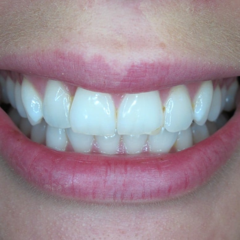 Amy After Treatment