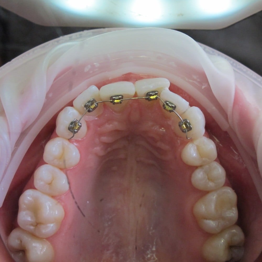 Amy Before Treatment