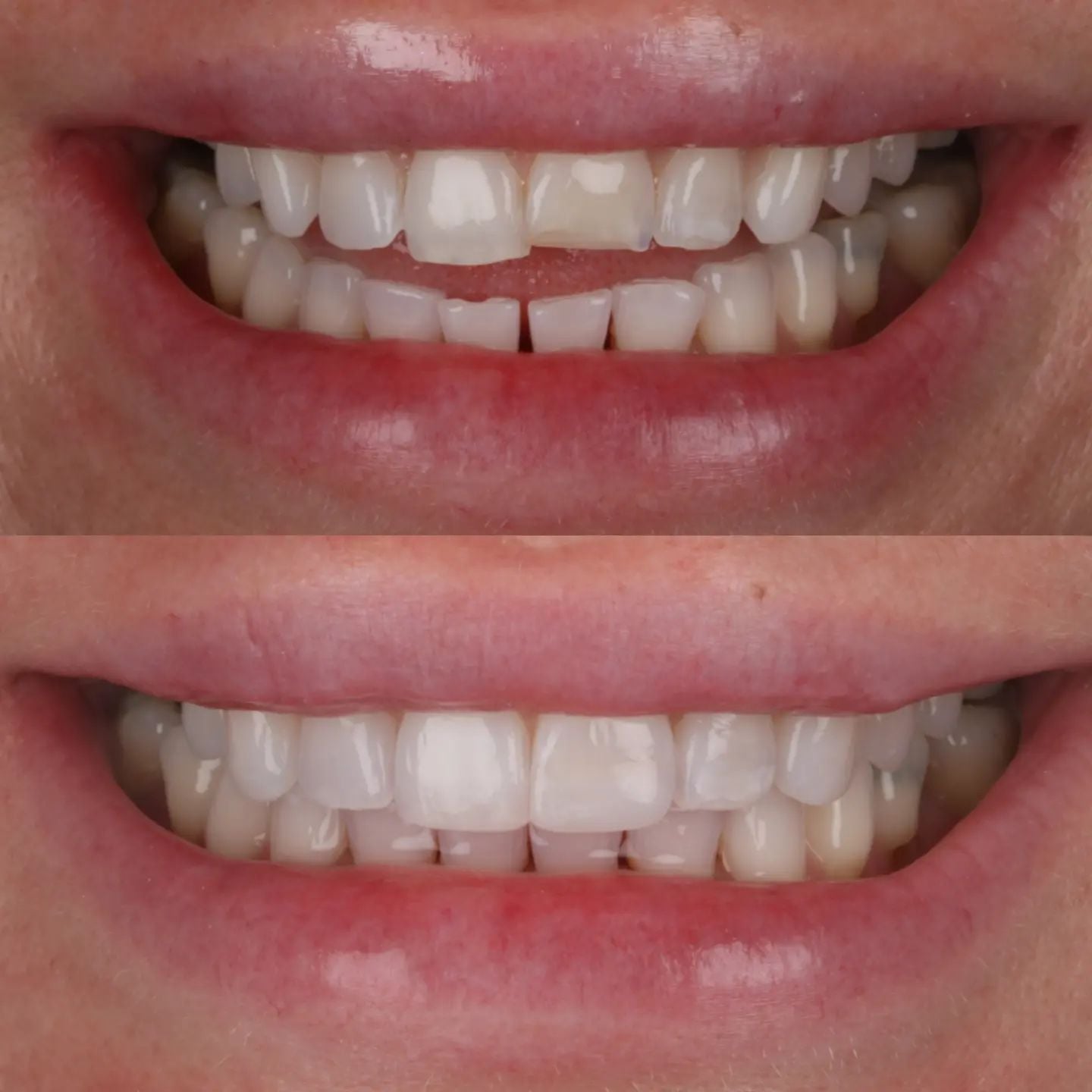 Rebecca Masterson | Dentistry @ No.3 & Century House Before & after treatment with Rebecca