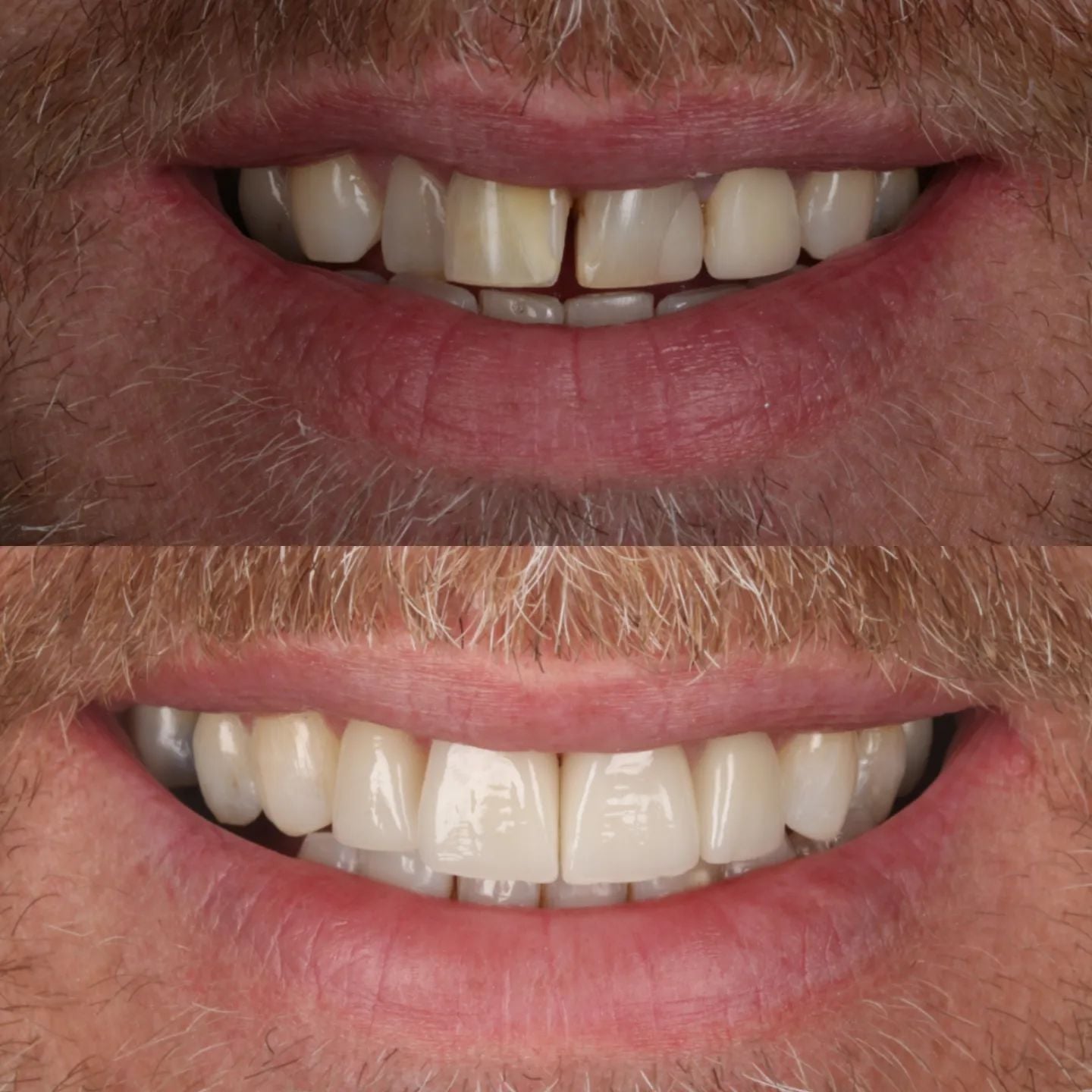 Rebecca Masterson | Dentistry @ No.3 & Century House Before & after treatment with Rebecca