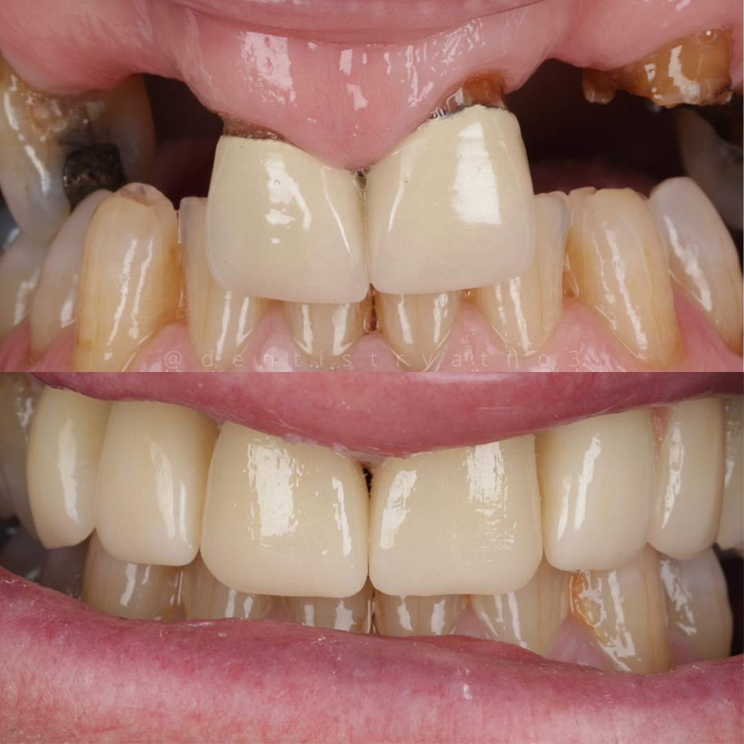 Dental Implants Dunfermline Replace Missing Teeth | Dentistry @ No.3 & Century House Dental Implants Treatment