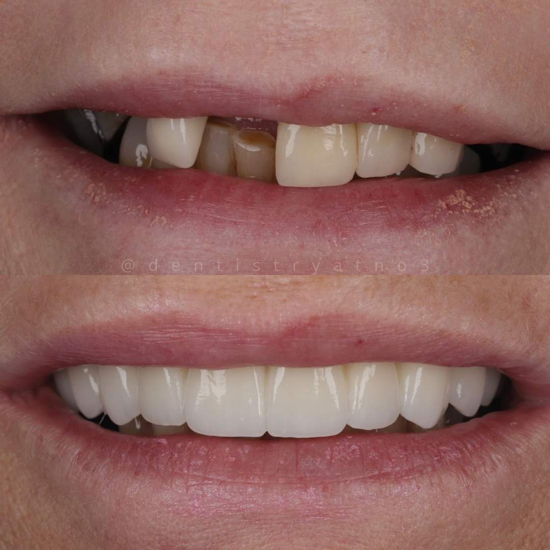 Dental Implants Dunfermline Replace Missing Teeth | Dentistry @ No.3 & Century House Dental Implants Treatment