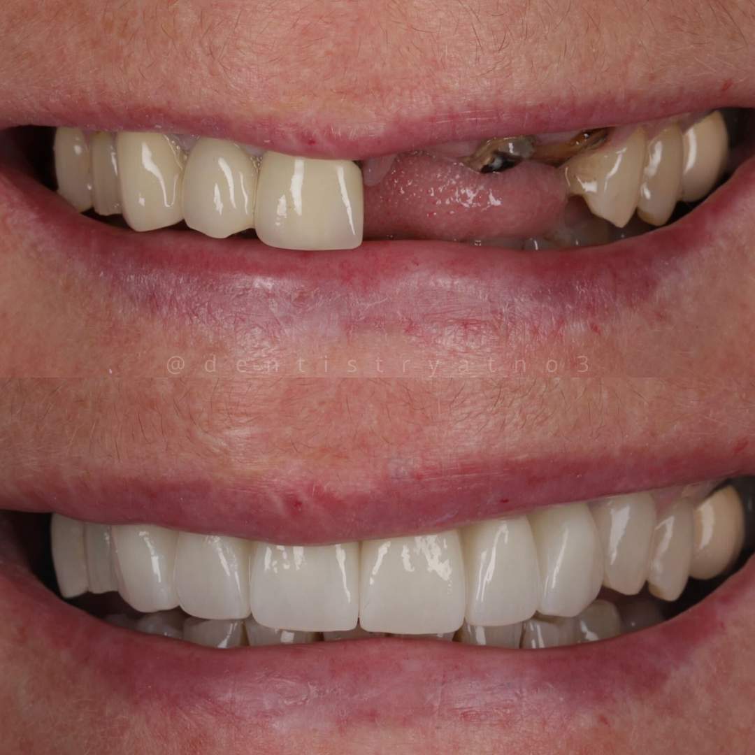 Dental Implants Dunfermline Replace Missing Teeth | Dentistry @ No.3 & Century House Dental Implants Treatment
