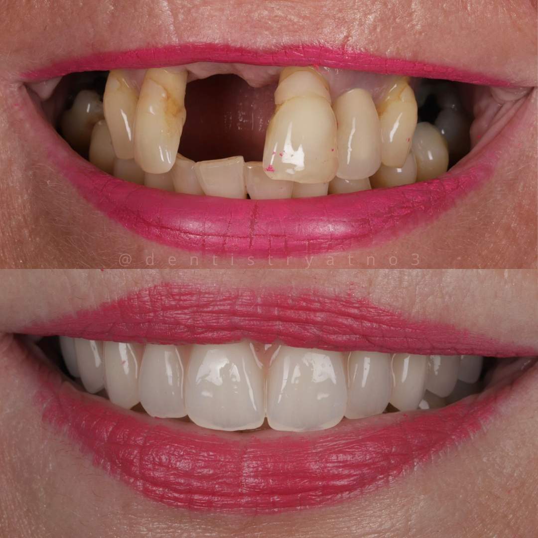 Dental Implants Dunfermline Replace Missing Teeth | Dentistry @ No.3 & Century House Dental Implants Treatment