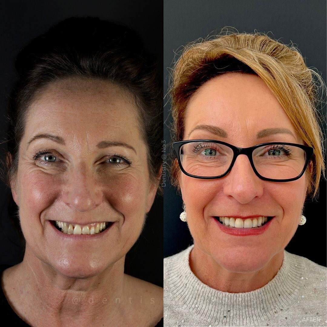 Invisalign & Veneers