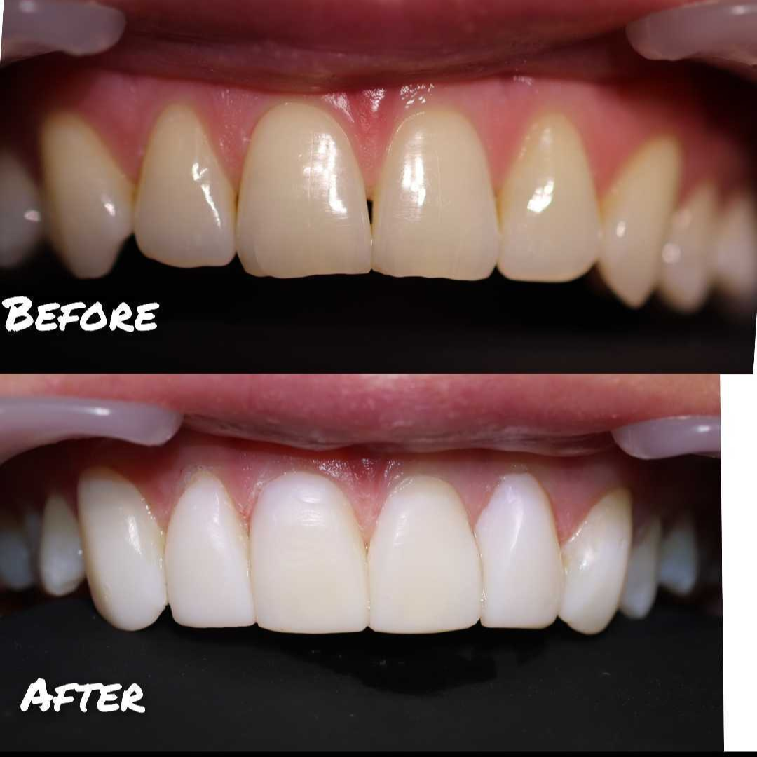 Before & after treatment with Lee