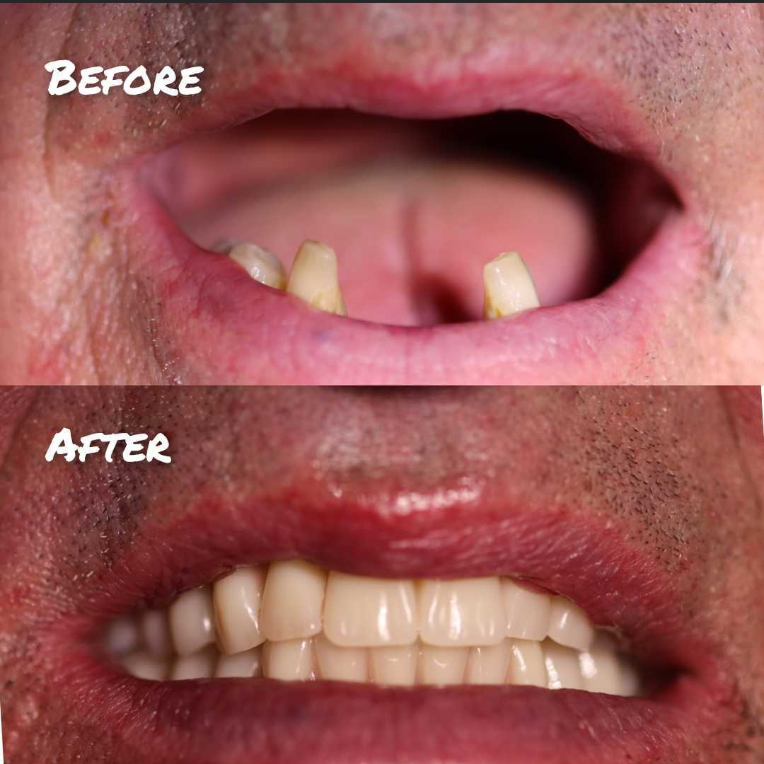 Before & after treatment with Lee