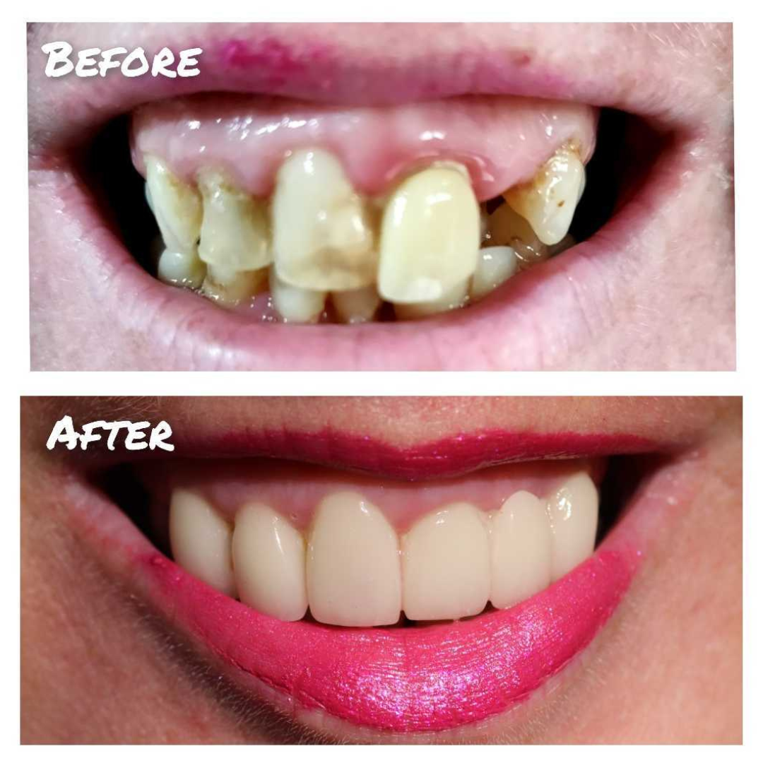 Before & after treatment with Lee