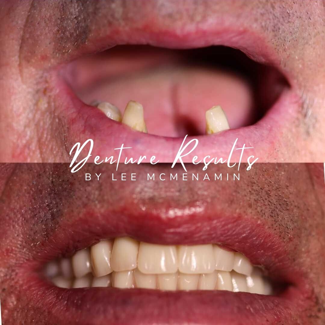 Dental Implants Dunfermline Replace Missing Teeth | Dentistry @ No.3 & Century House Dental Implants Treatment