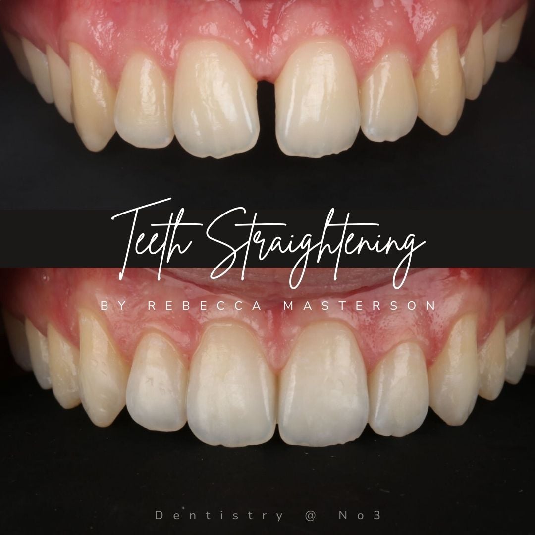 Before and after treatment at Dentistry @ No.3 in Dunfermline