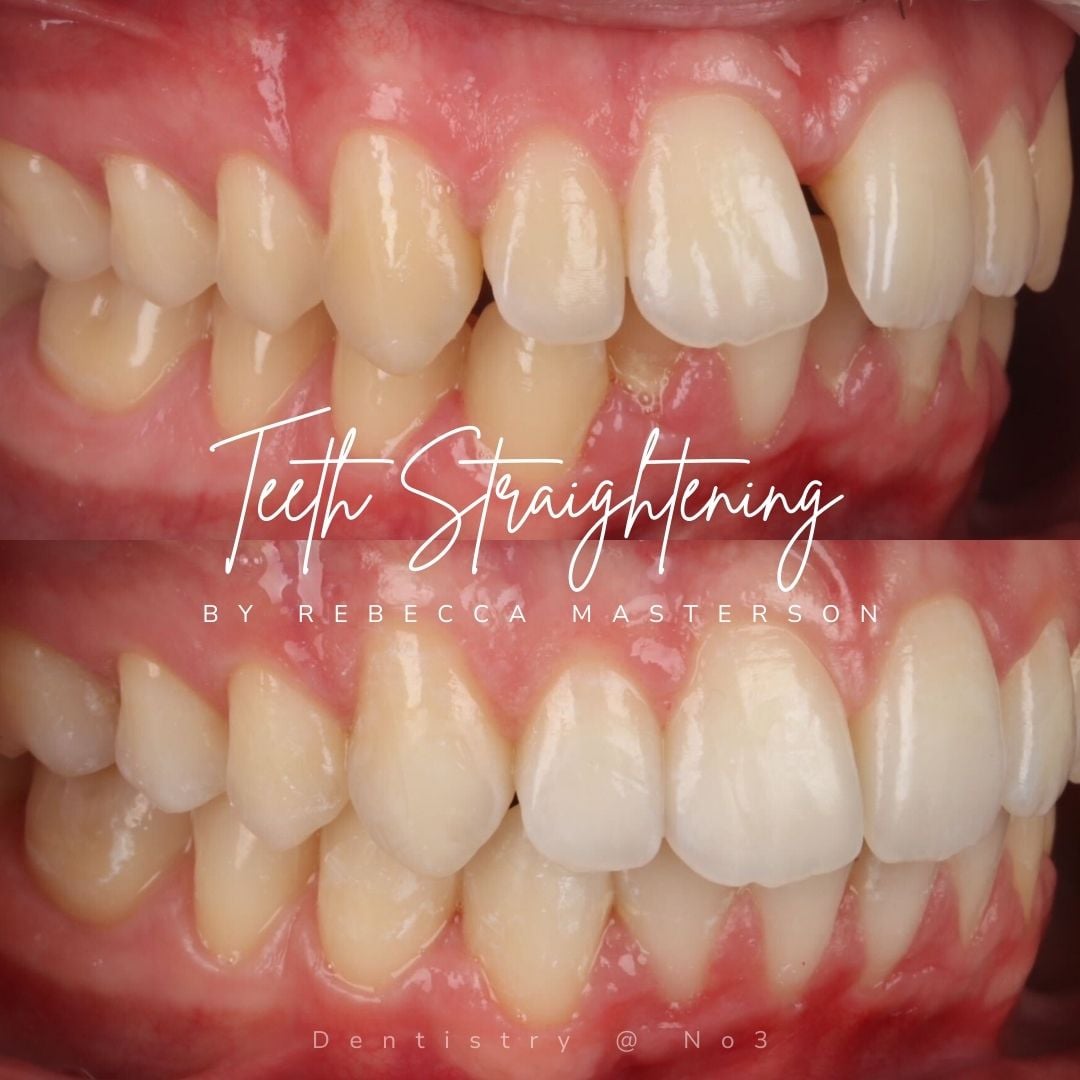 Before and after treatment at Dentistry @ No.3 in Dunfermline