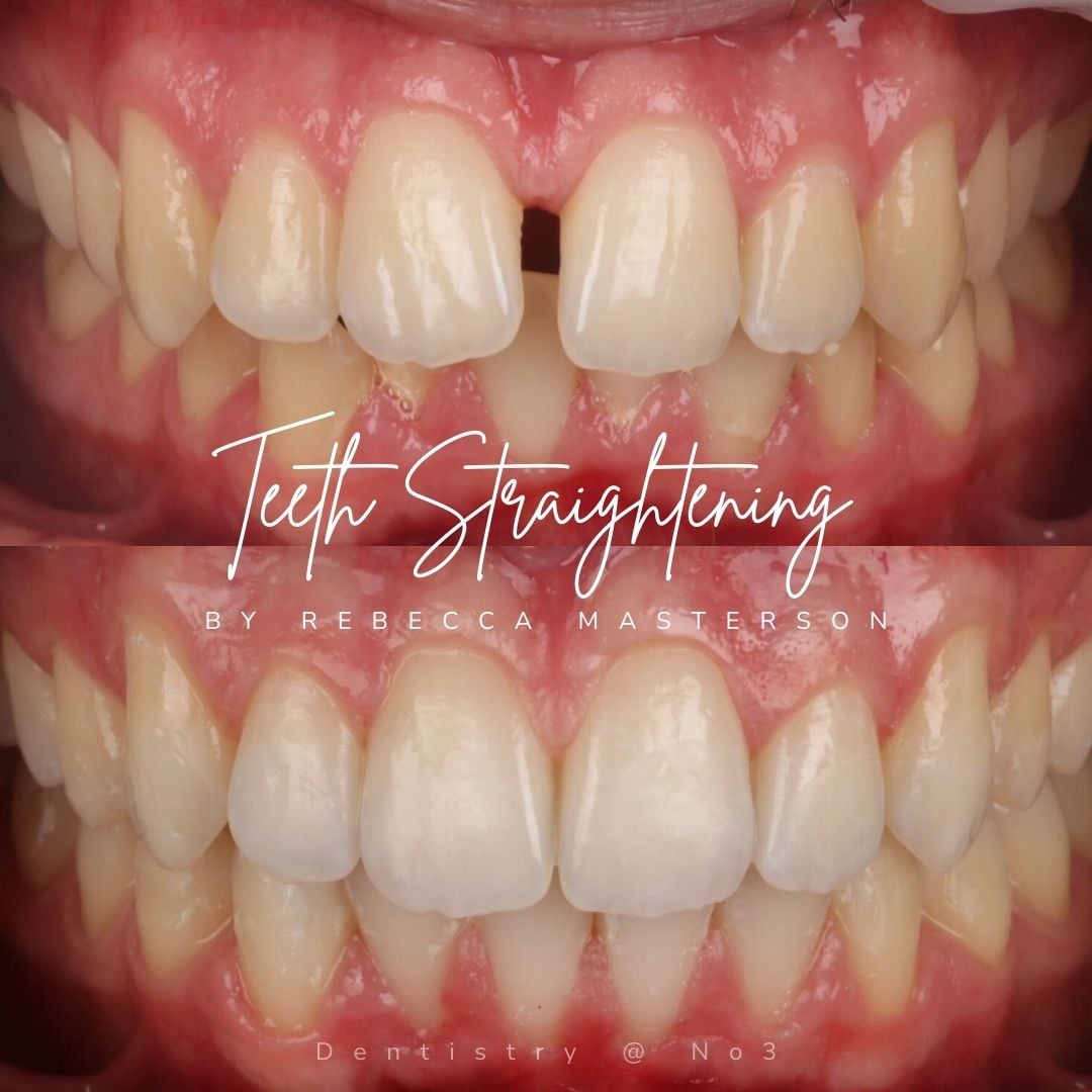 Before and after treatment at Dentistry @ No.3 in Dunfermline