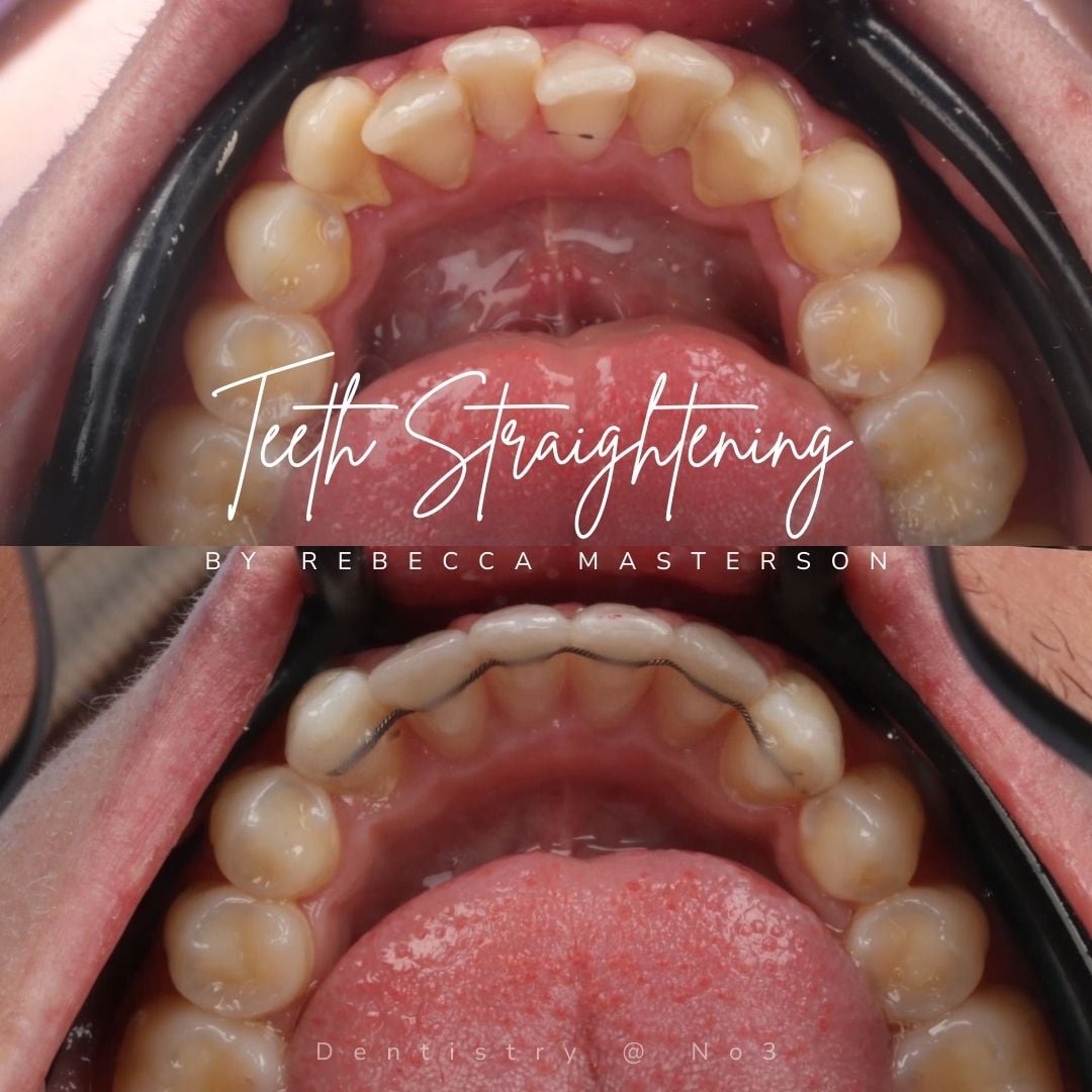 Before and after treatment at Dentistry @ No.3 in Dunfermline