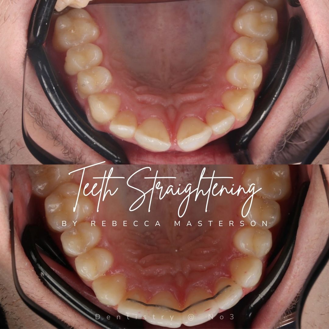 Before and after treatment at Dentistry @ No.3 in Dunfermline
