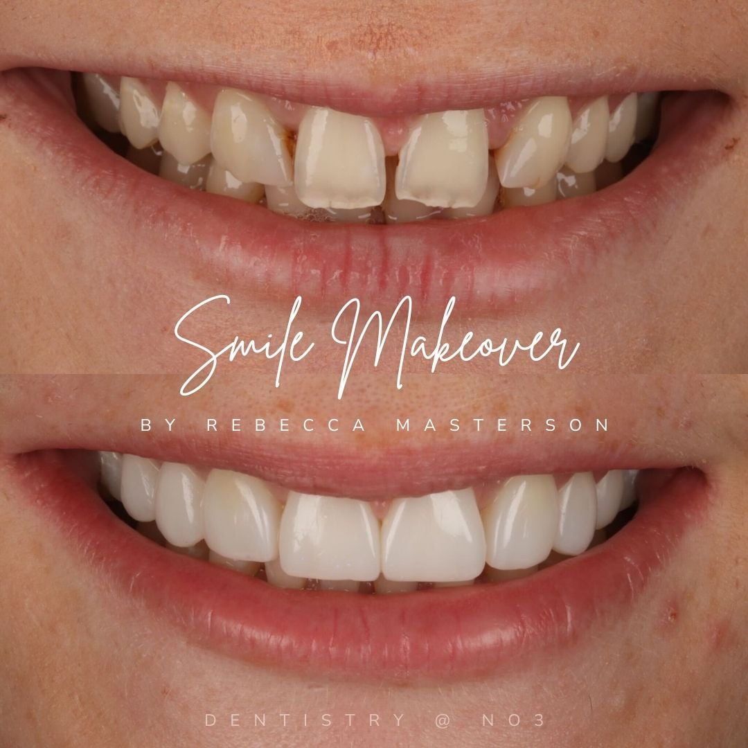 Before and after treatment at Dentistry @ No.3