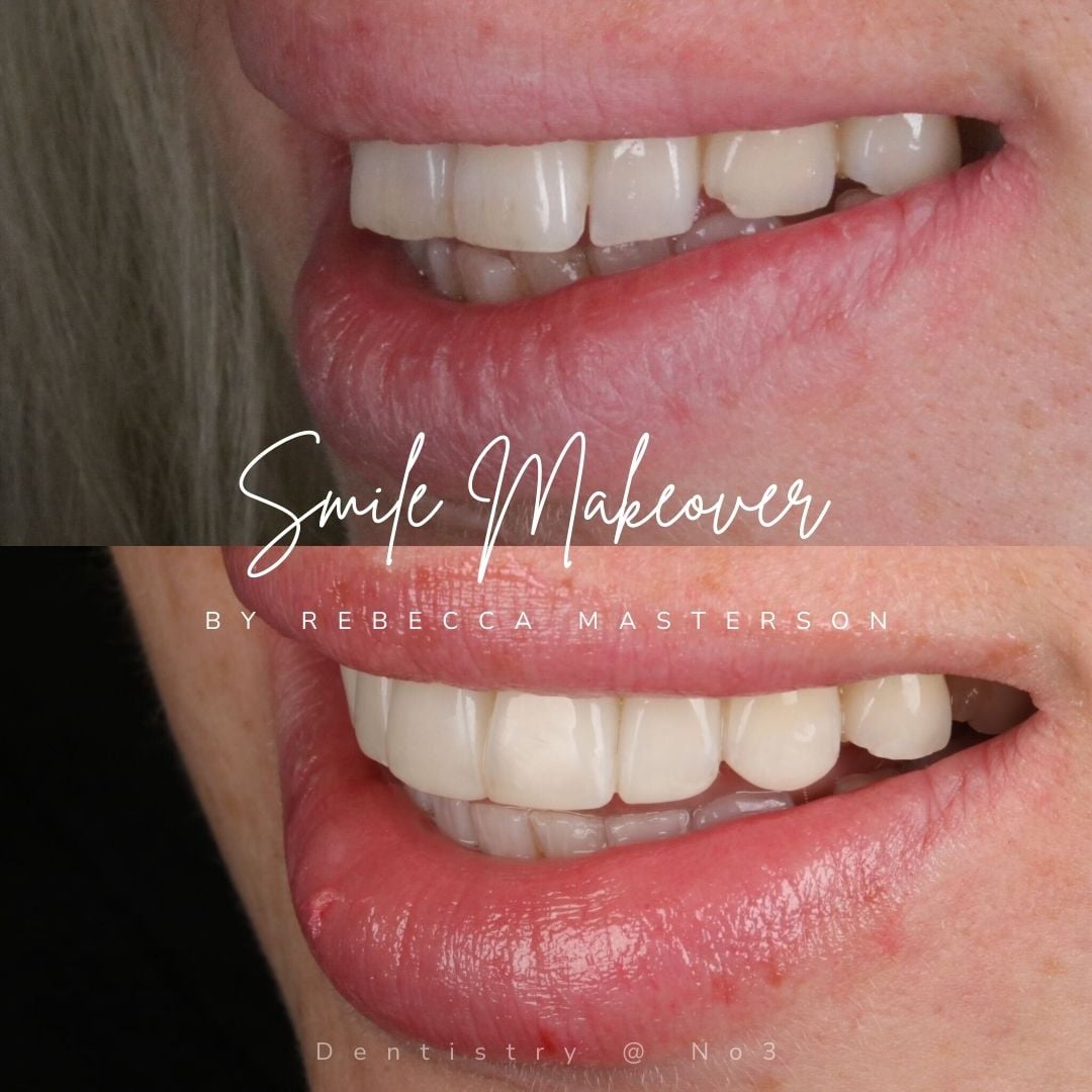 Before and after treatment at Dentistry @ No.3