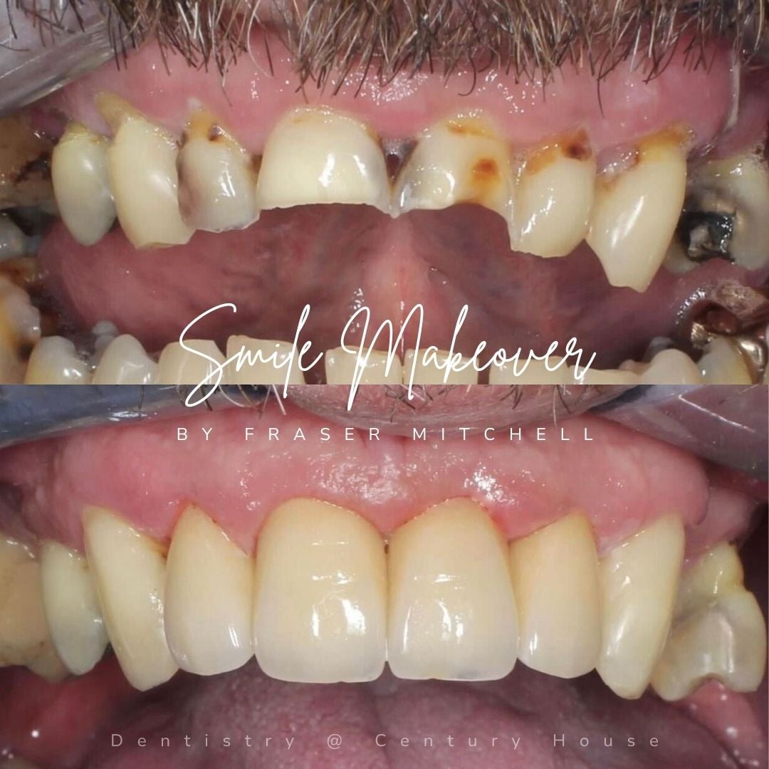 Dental Veneers | Dentistry @ No.3 & Century House Dental Veneers | Dentistry @ No.3 & Century House