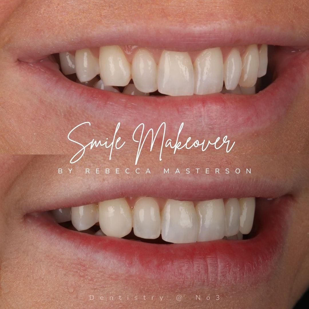 Before and after treatment at Dentistry @ No.3