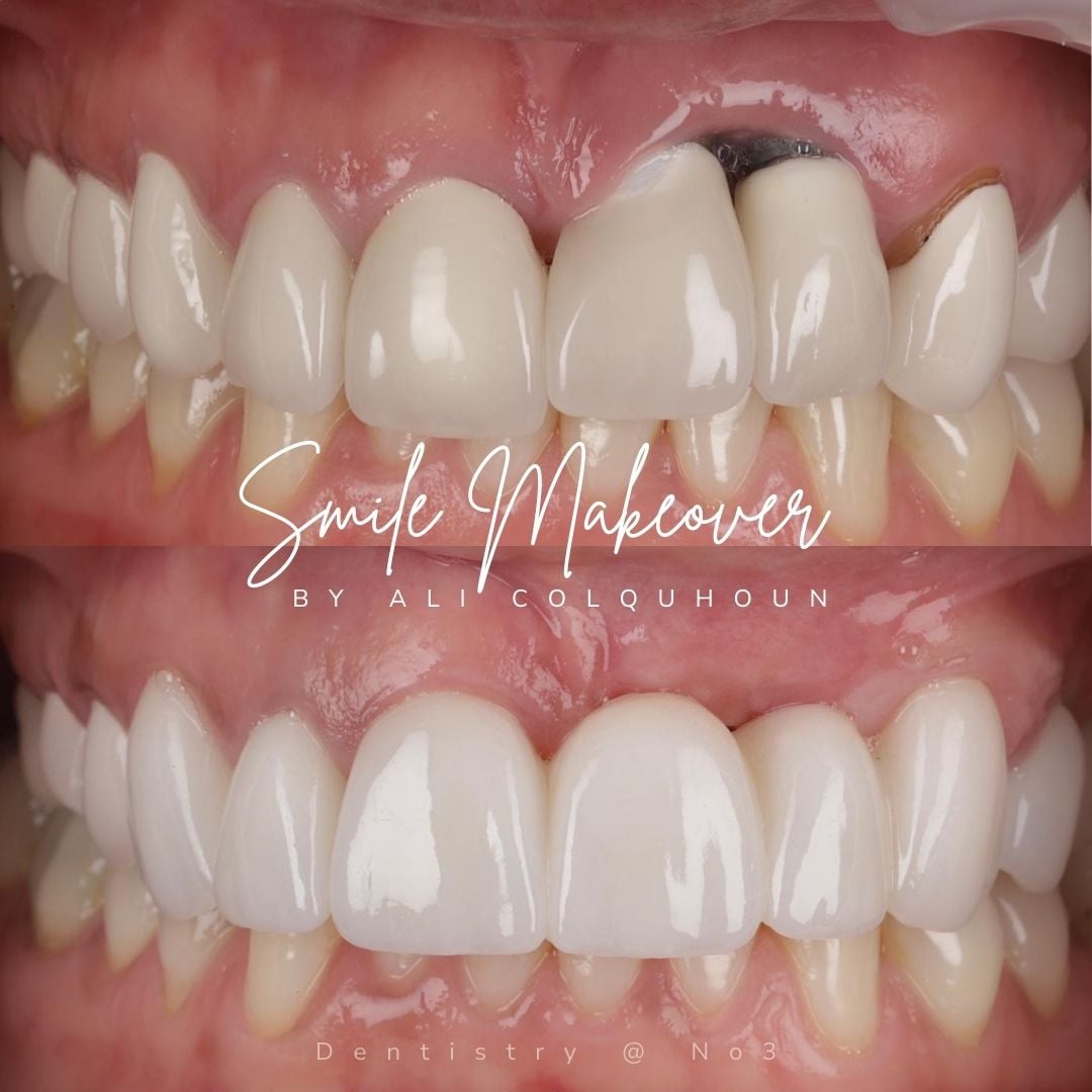 Before and after treatment at Dentistry @ No.3