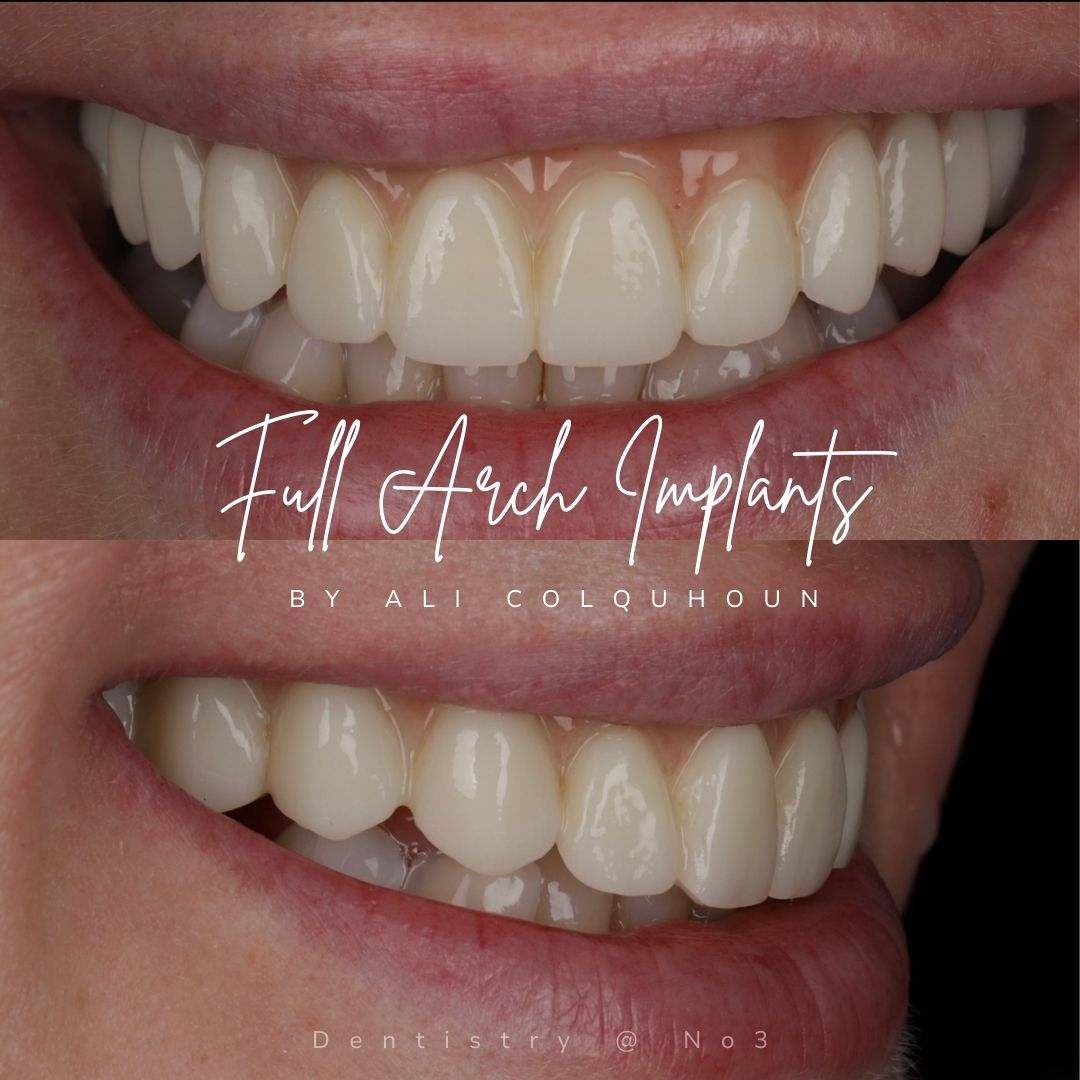 Dental Implants Dunfermline Replace Missing Teeth | Dentistry @ No.3 & Century House Dental Implants Treatment