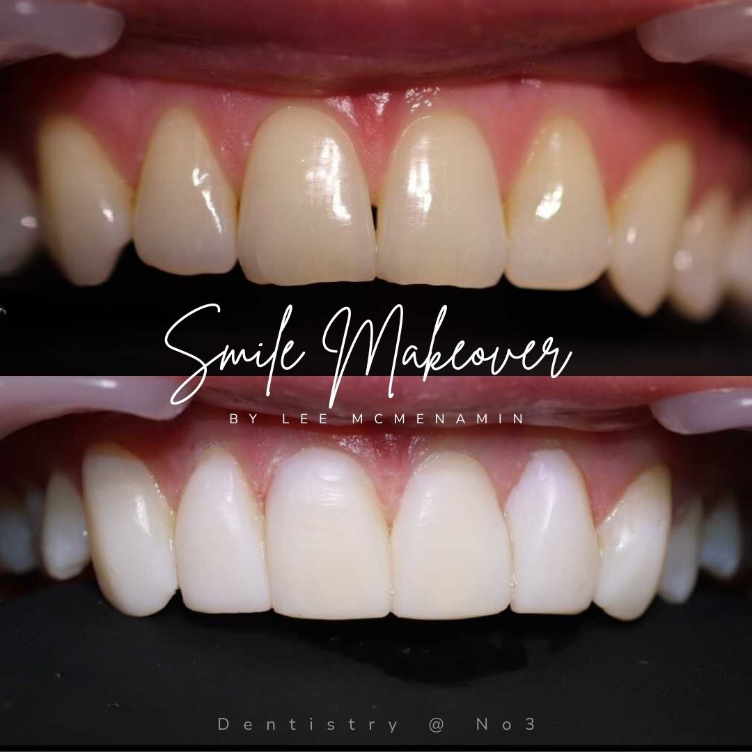 Dental Veneers | Dentistry @ No.3 & Century House Dental Veneers | Dentistry @ No.3 & Century House