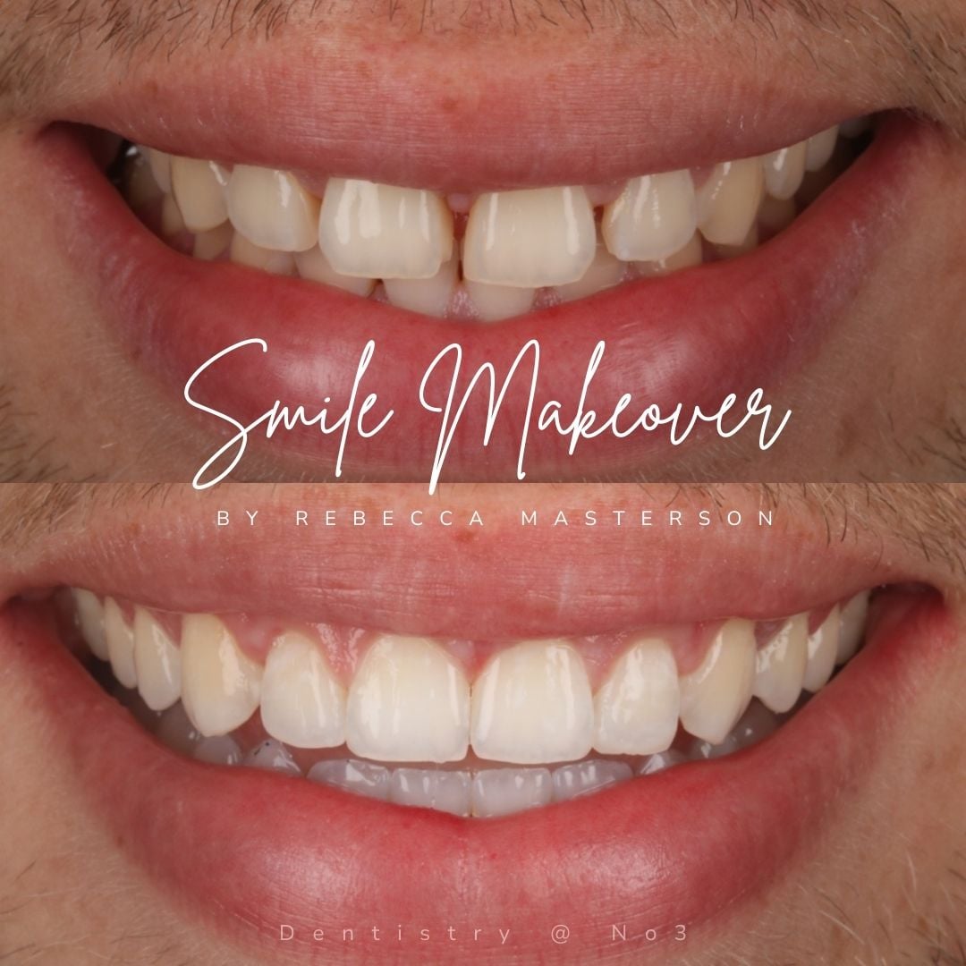 Dental Veneers | Dentistry @ No.3 & Century House Dental Veneers | Dentistry @ No.3 & Century House