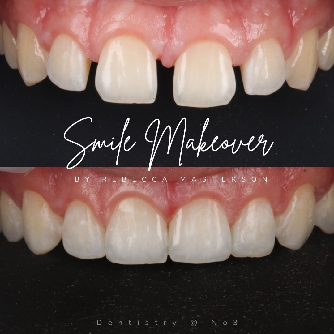 Dental Veneers | Dentistry @ No.3 & Century House Dental Veneers | Dentistry @ No.3 & Century House