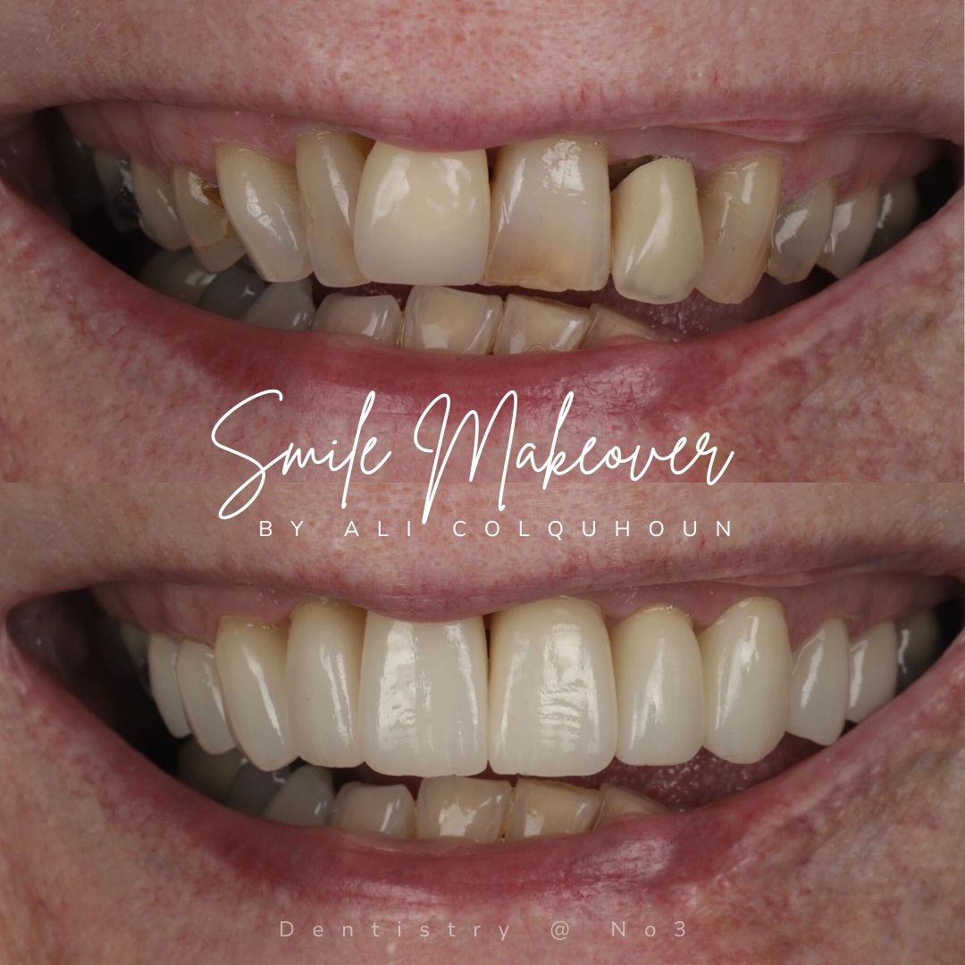 Before and after treatment at Dentistry @ No.3