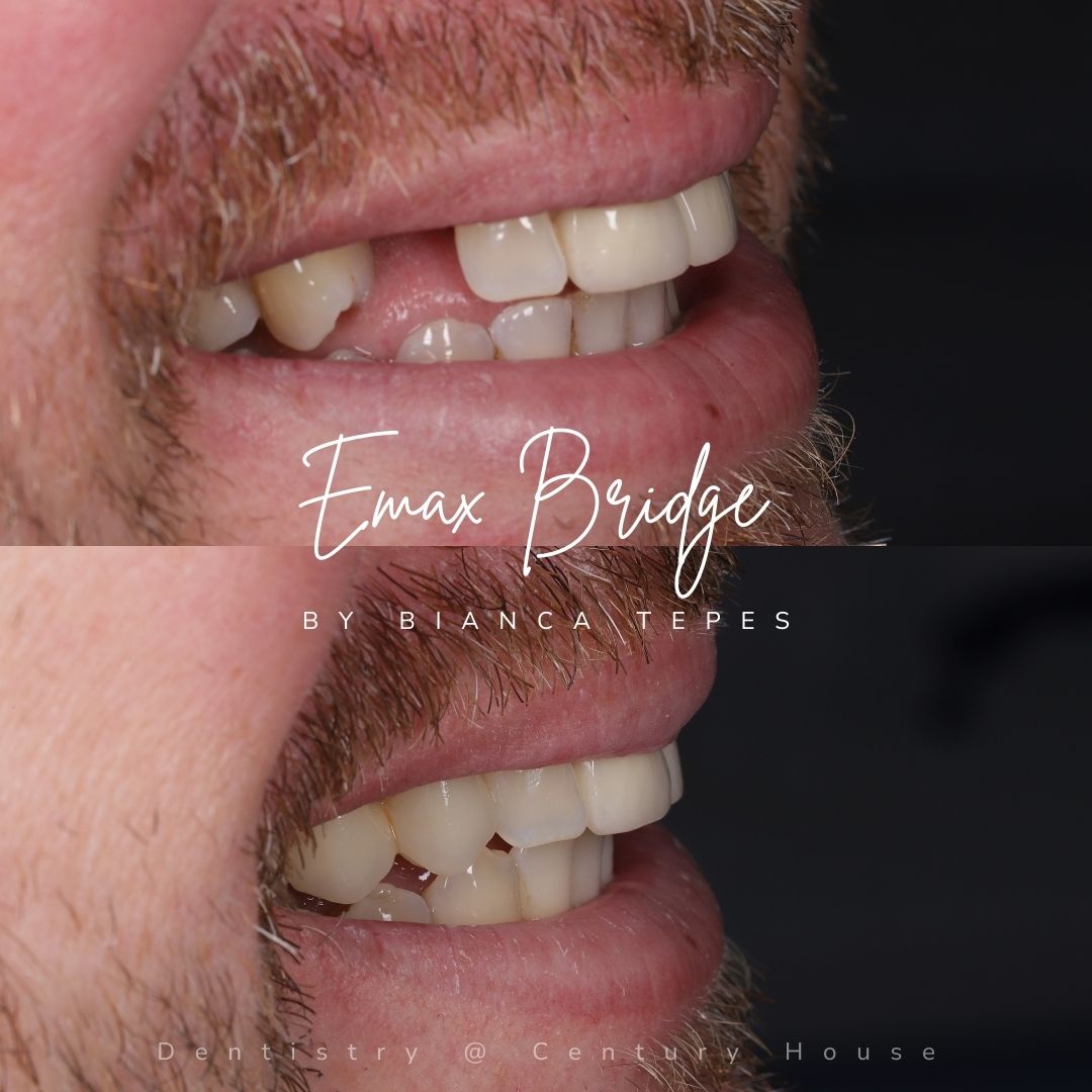 Dental Implants Dunfermline Replace Missing Teeth | Dentistry @ No.3 & Century House Dental Implants Treatment