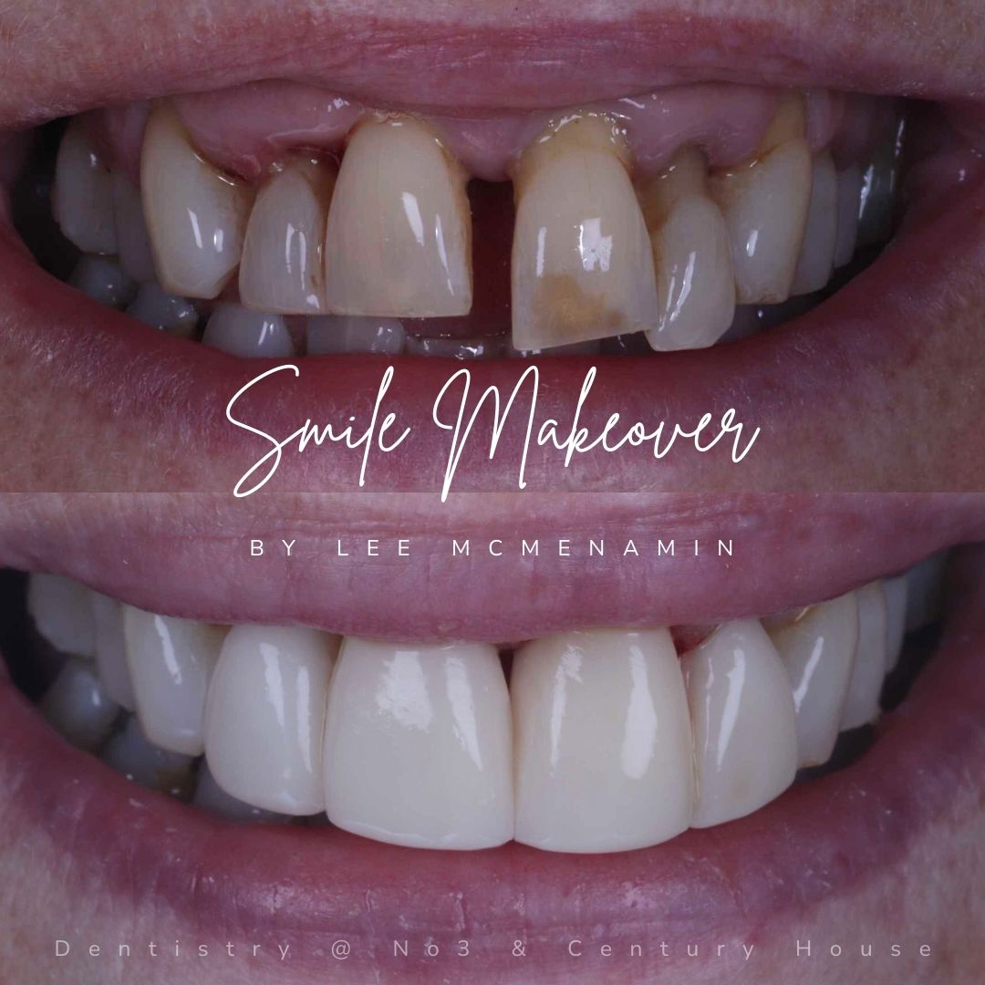 Before and after treatment at Dentistry @ No.3
