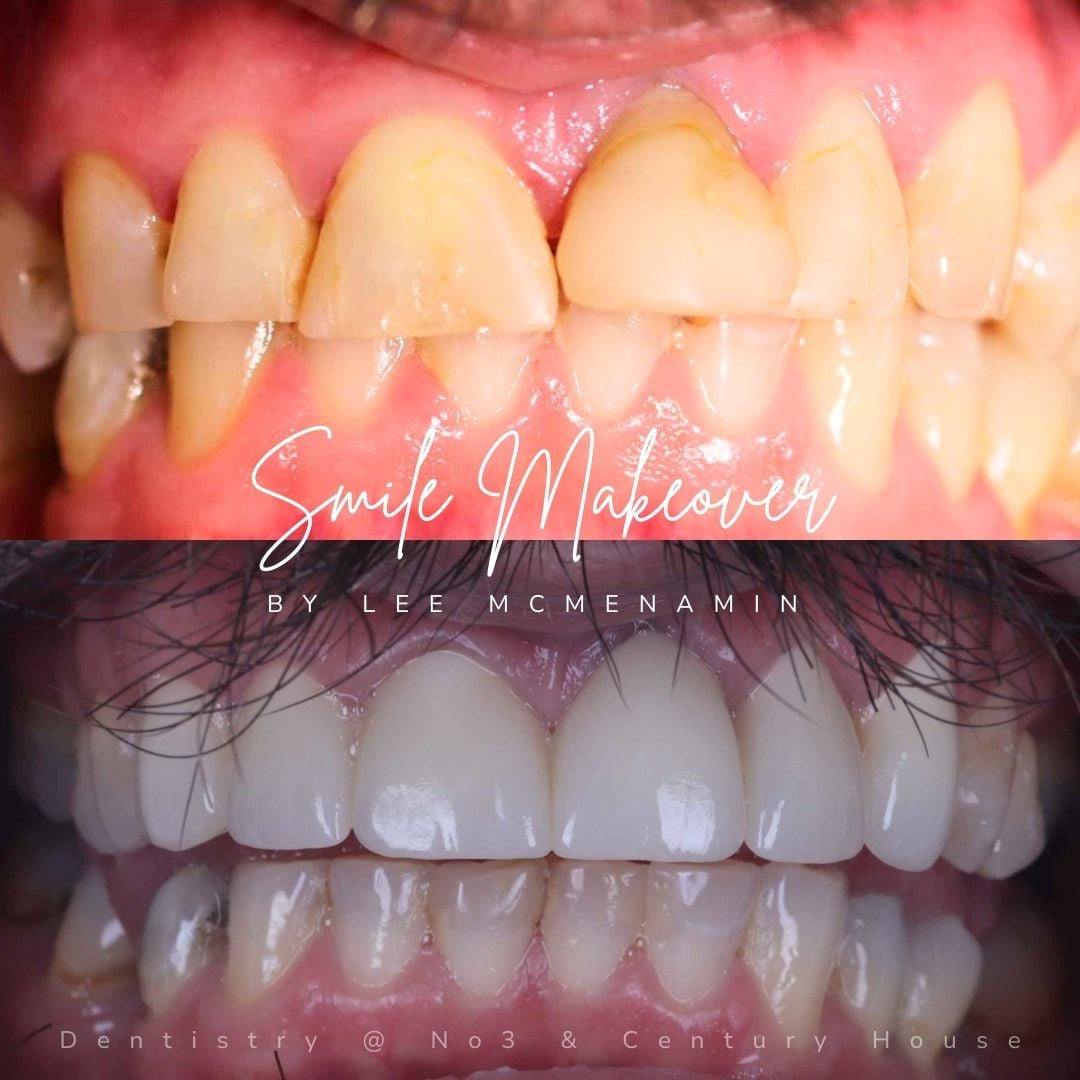 Dental Veneers | Dentistry @ No.3 & Century House Dental Veneers | Dentistry @ No.3 & Century House