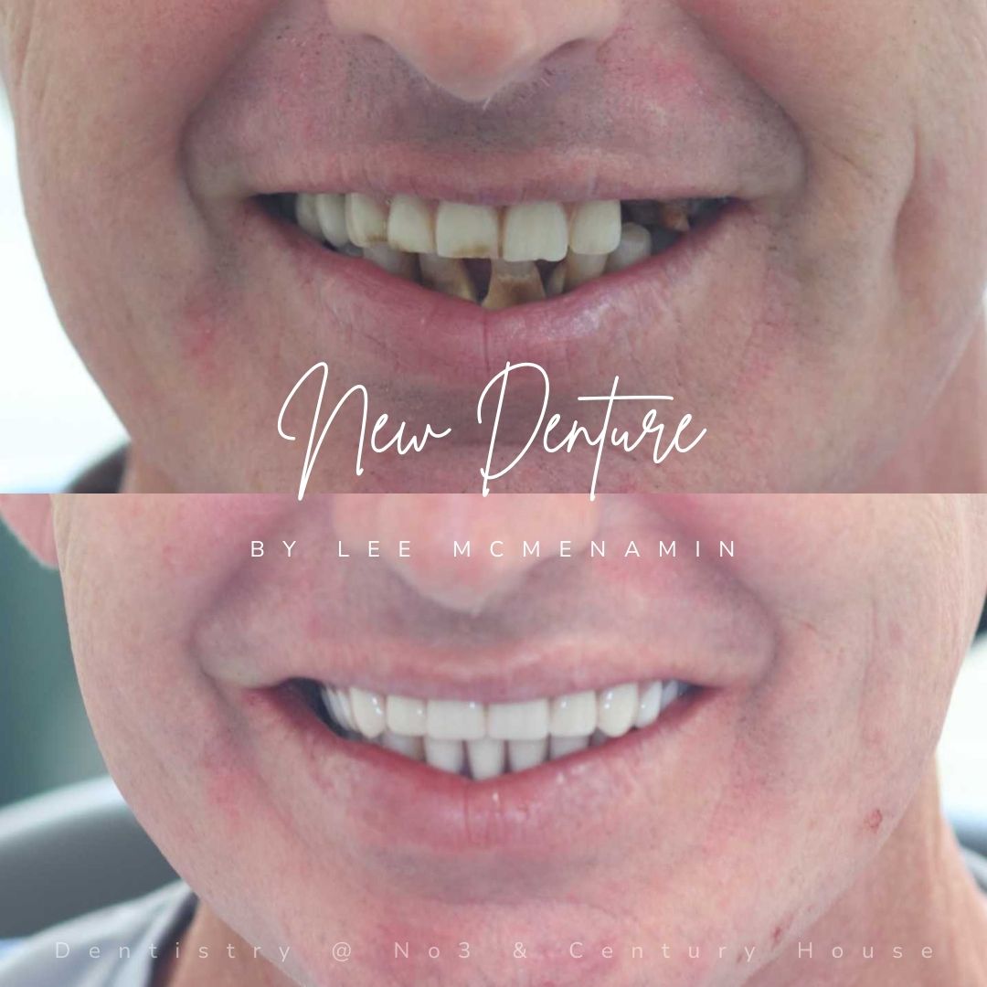 Dental Implants Dunfermline Replace Missing Teeth | Dentistry @ No.3 & Century House Dental Implants Treatment
