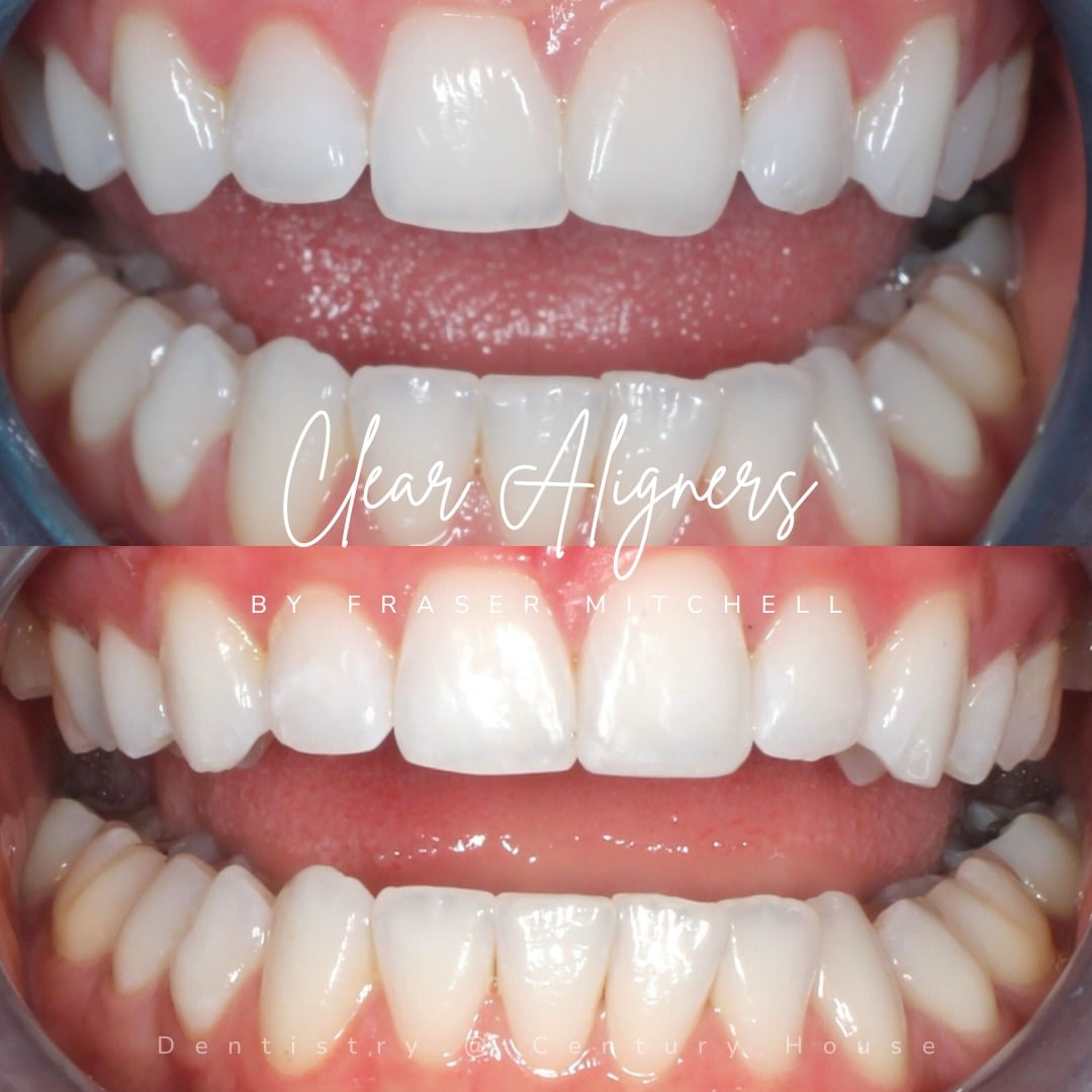 Straight Teeth System | Dentistry @ No.3 & Century House
