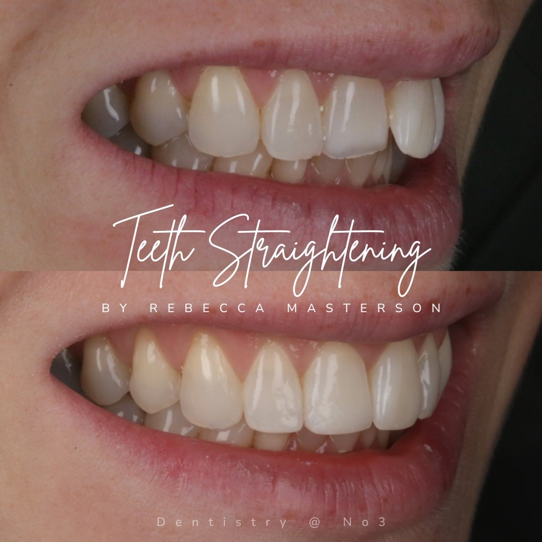Straight Teeth System | Dentistry @ No.3 & Century House
