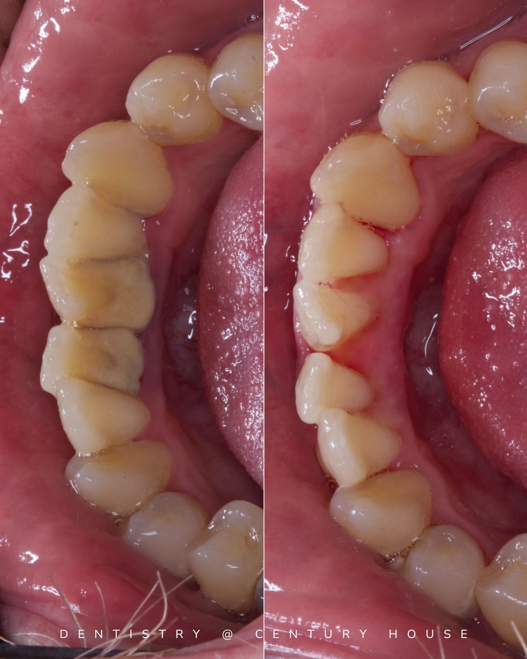 Before and after treatment