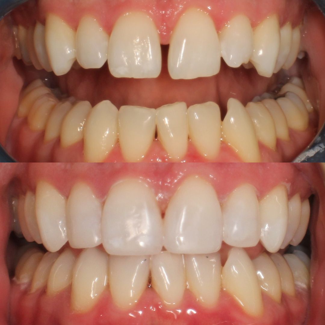 Before & after treatment with Fraser