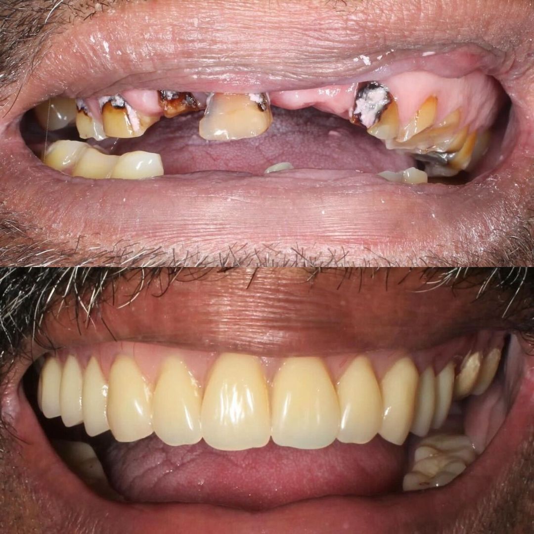 Before & after treatment with Fraser