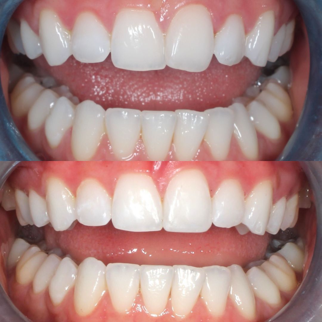Before & after treatment with Fraser